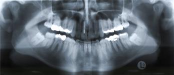 (E) Orthopantomogramm (OPT)