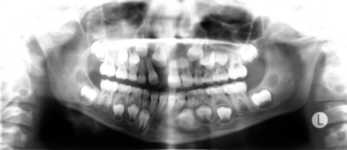 (A) Orthopantomogramm (OPT) 2