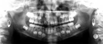 (A) Orthopantomogramm (OPT)