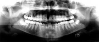 (B3) Orthopantomogramm (OPT)